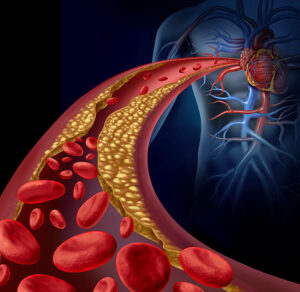 Illustration of clogged artery and atherosclerosis disease medical concept with a three dimensional human artery with blood cells that is blocked by plaque buildup of cholesterol