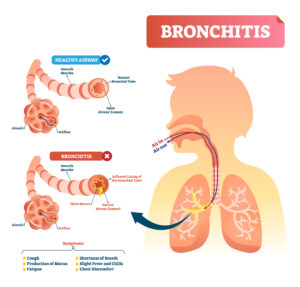 Bronchitis - Lung disease diagnosis